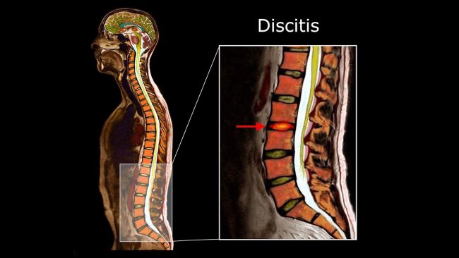 symptoms of discitis