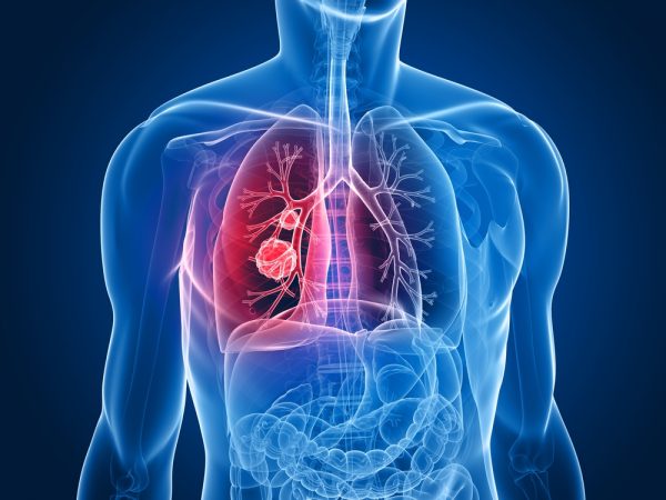 lung cancer diagnosis