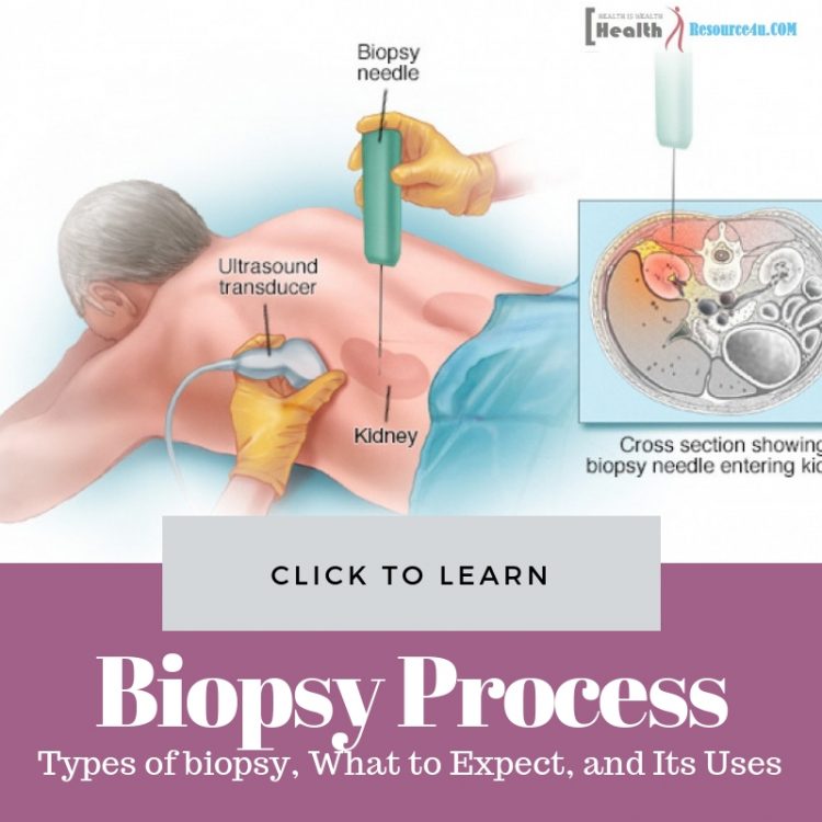 what is Biopsy