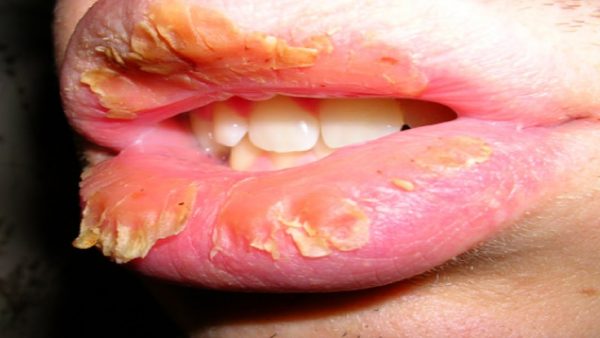 treatment of chapped lips
