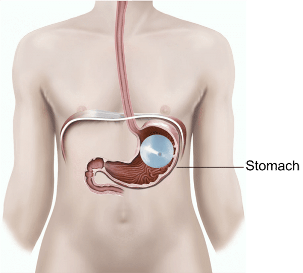 gastric balloons are the best way to lose weight