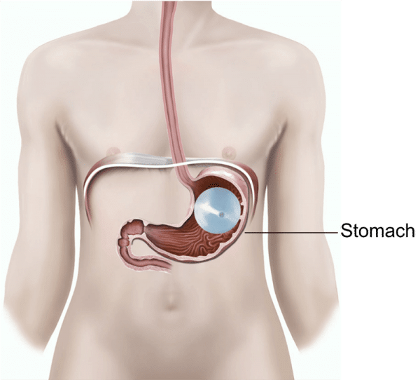 gastric balloons are the best way to lose weight 