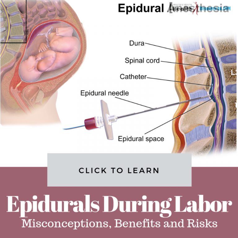 Epidurals During Labor