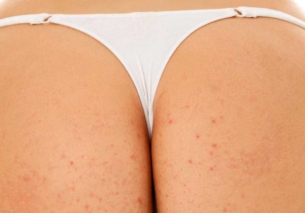 butt acne