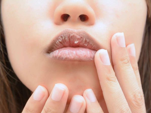 ways to get rid of dry lips