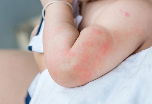 treatment of hives