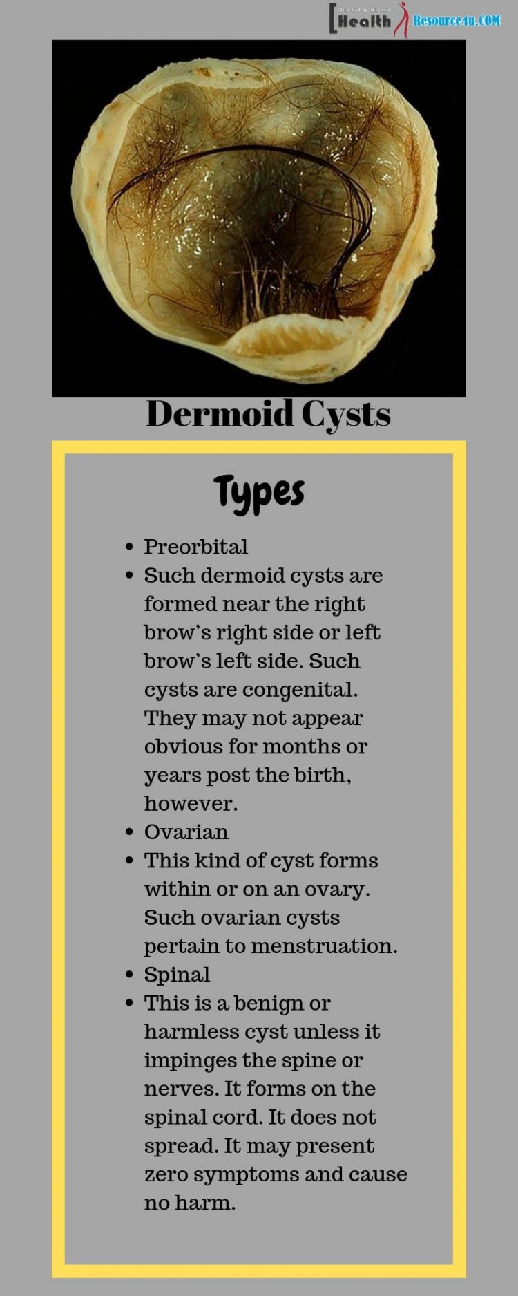 Dermoid Cyst Infographic