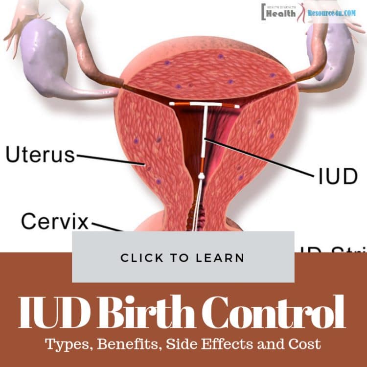 IUD Birth Control