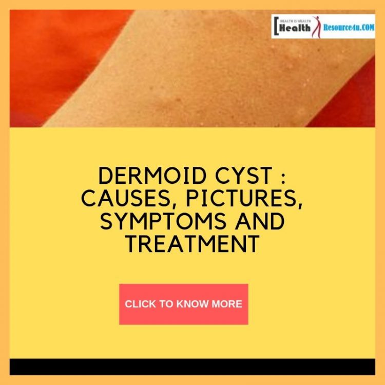 dermoid cyst