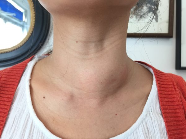 remedies to cure goiter at home