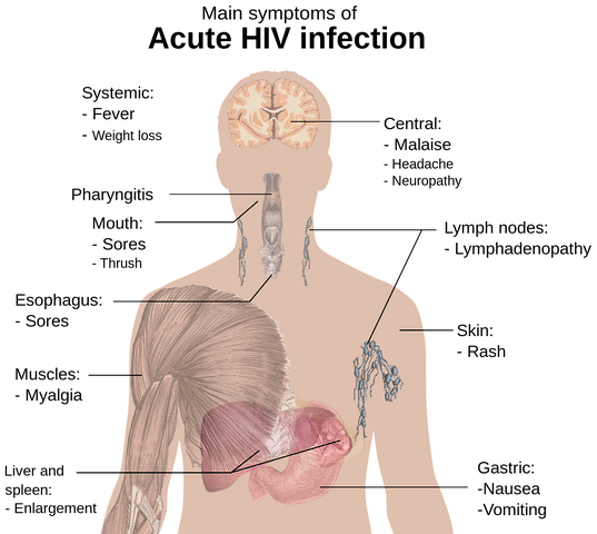 Late Stage HIV Symptoms