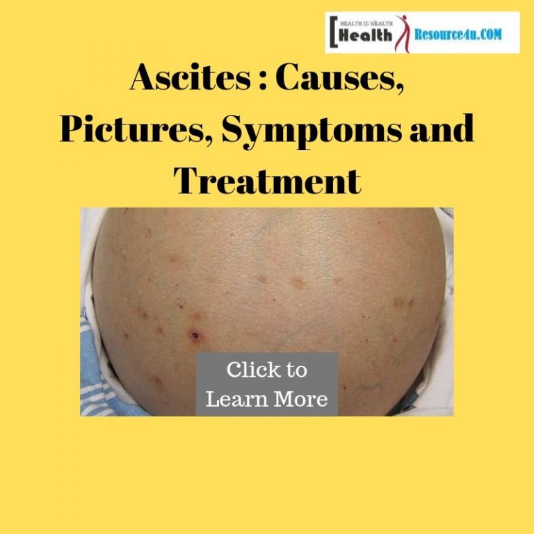 Ascites: Causes, Pictures, Symptoms And Treatment