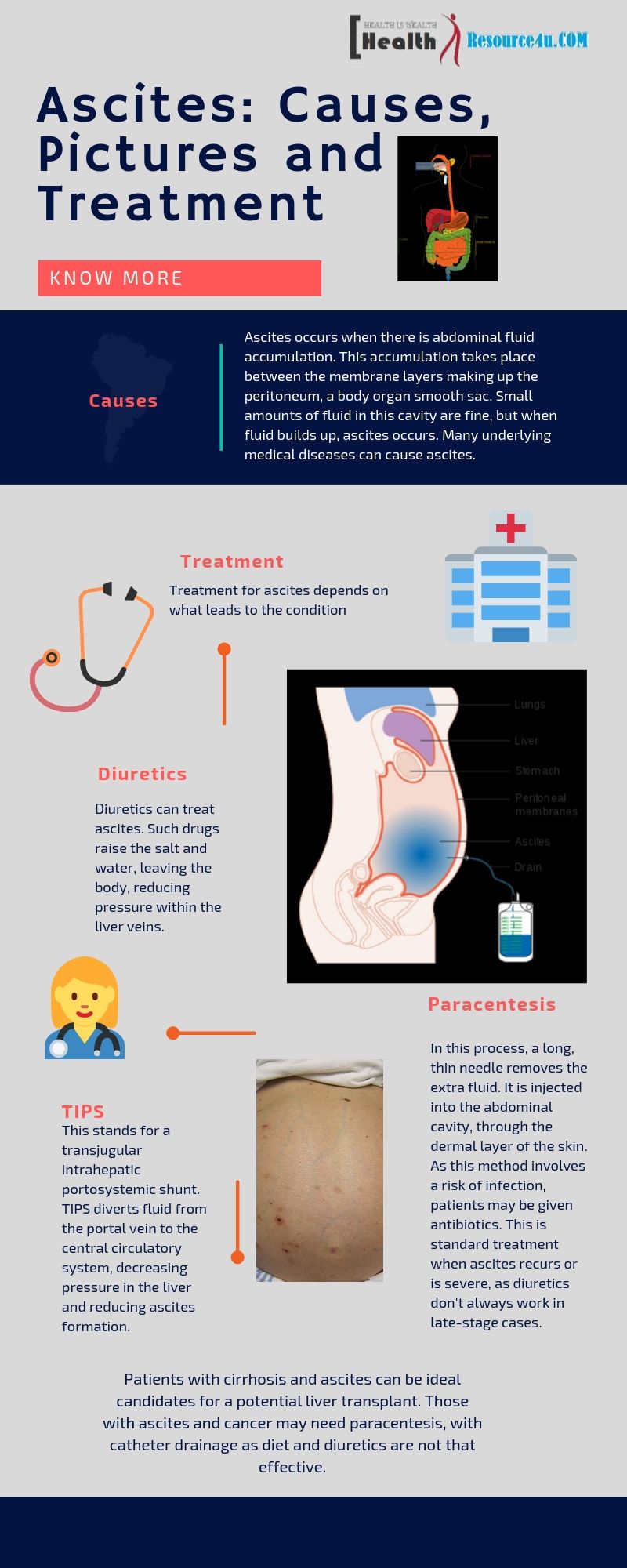 Treatment and Management of Ascites Infographic