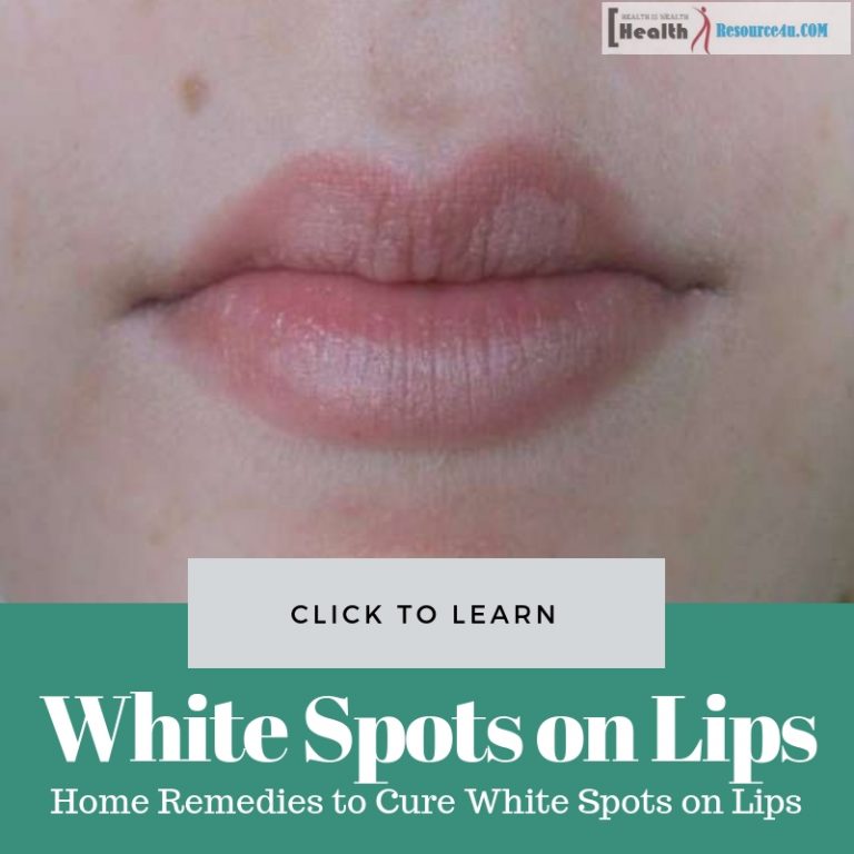 Home Remedies to Cure White Spots on Lips