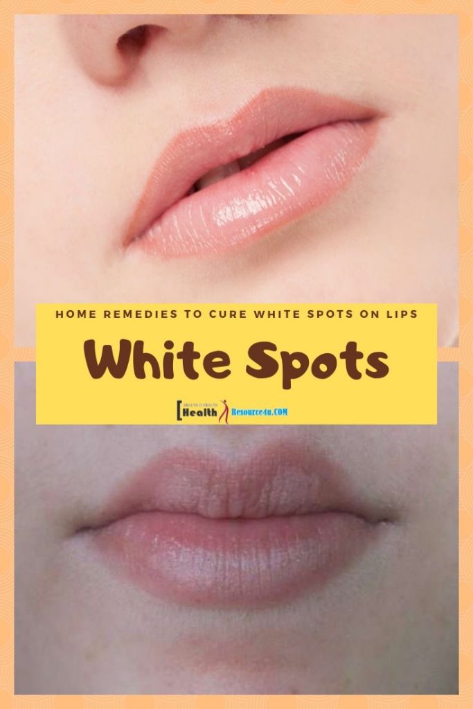 7 Effective Home Remedies To Cure White Spots On Lips