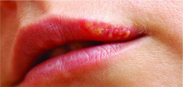 home remedies to cure white spots on lips