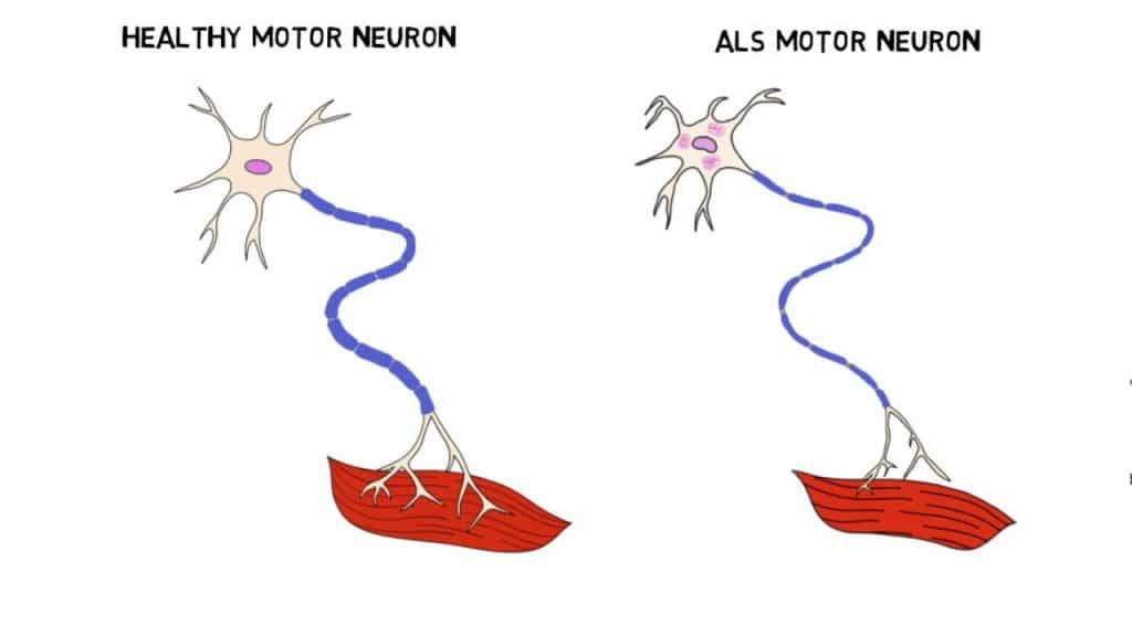 causes of amyotrophic lateral sclerosis