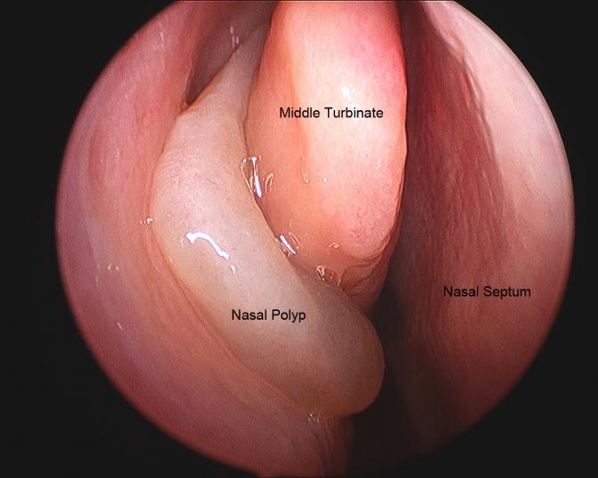 Nasal polyps