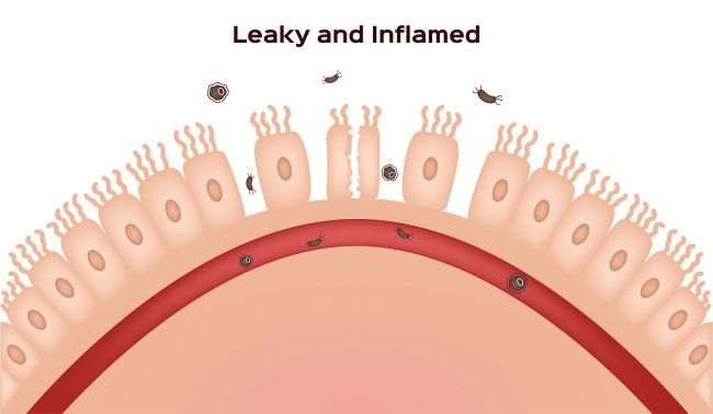 symptoms of leaky gut syndrome