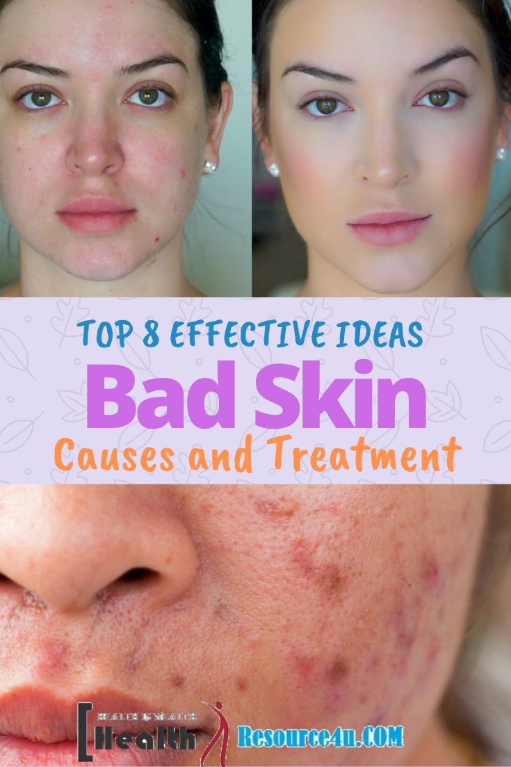 Bad Skin Causes Treatment