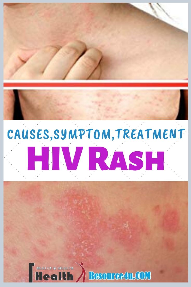 HIV Rash Causes Treatment