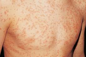 HIV rash symptoms 