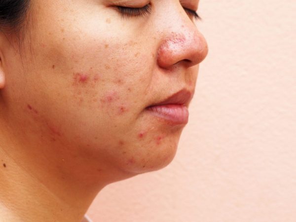 combat bad skin causes