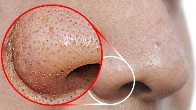 home remedies to treat blackheads