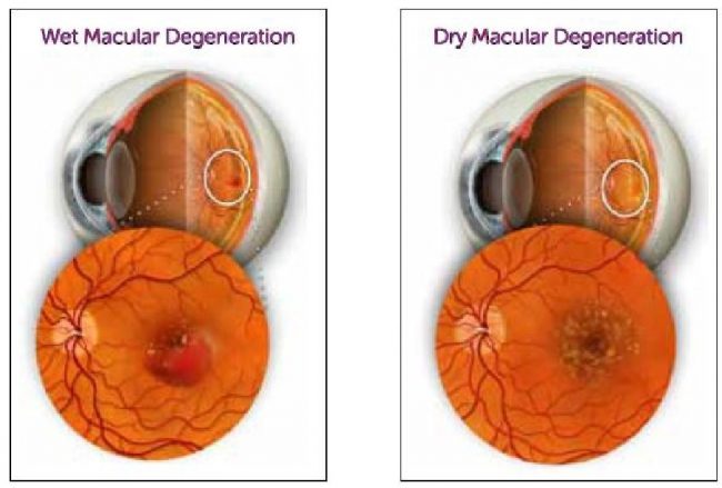 symptoms of macular degeneration