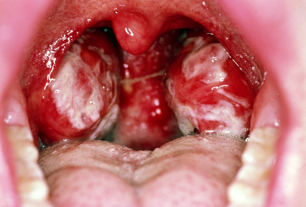 treatment of mononucleosis