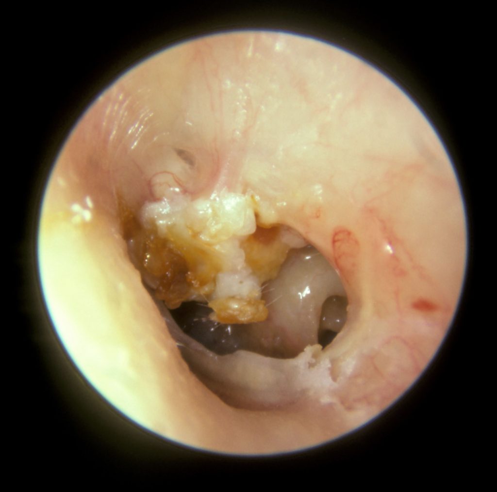 symptoms of cholesteatoma