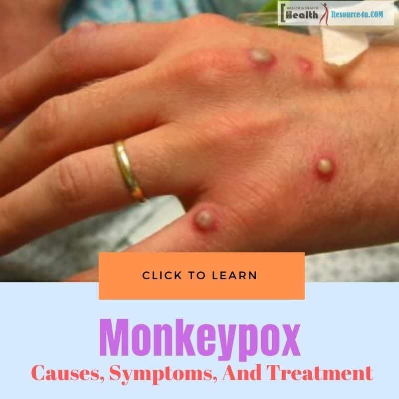 Monkeypox: Causes, Symptoms, Diagnosis, Treatment