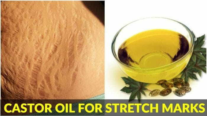 Ways To Use Castor Oil For Treating Stretch Marks