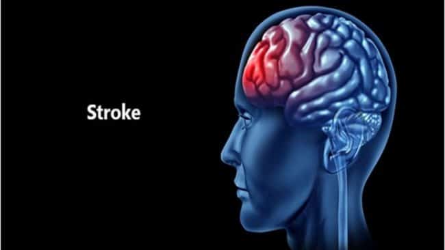 symptoms of a stroke