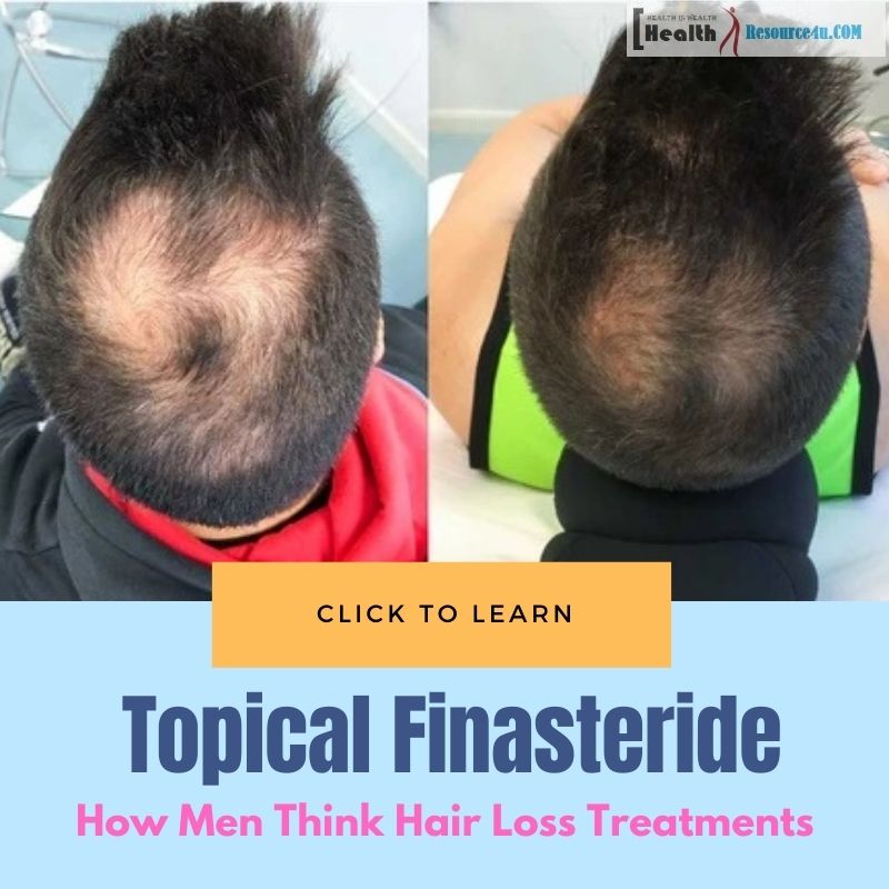 Topical Finasteride