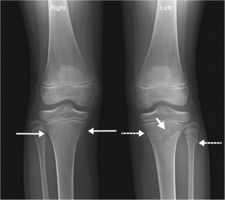 buckle fracture buckle fracture