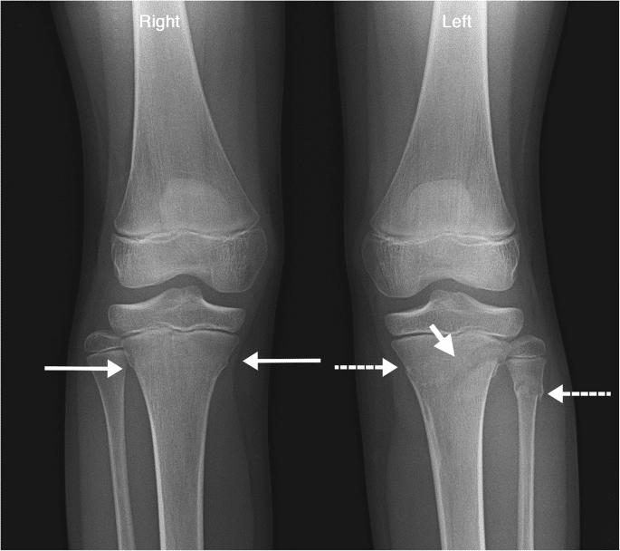 Buckle fracture