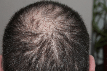 hair restoration procedure